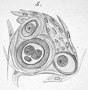 Illustration aus dem "Archiv für pathologische Anatomie und Physiologie und für klinische Medizin", herausgegeben von R. Virchow und B. Reinhardt, 3. Band, Berlin, 1851