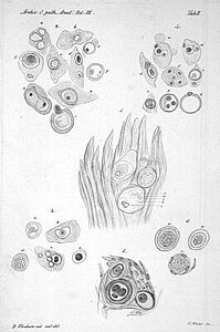 Illustration aus dem "Archiv für pathologische Anatomie und Physiologie und für klinische Medizin", herausgegeben von R. Virchow und B. Reinhardt, 3. Band, Berlin, 1851